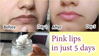 Pink lips in 5 days parmanently  Easy effective home remedy for dark lips [upl. by Kirby585]