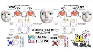 INSTANT NEURO  Caloric Testing [upl. by Delphine]