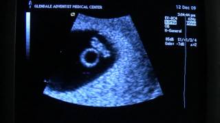 Ultrasound 6 weeks 6 days  Heartbeat [upl. by Alleen634]