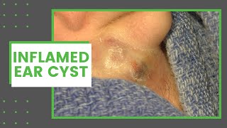 Inflamed Ear Cyst  Dr Derm [upl. by Bob219]