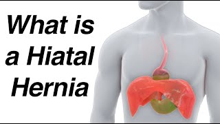 What is a Hiatal Hernia Animation amp How It Causes Reflux [upl. by Silverman793]