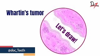 Whartin Tumor Histopathological features Lets draw [upl. by Omarr228]