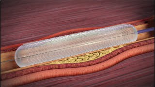 What is a Coronary Angioplasty [upl. by Aletha]