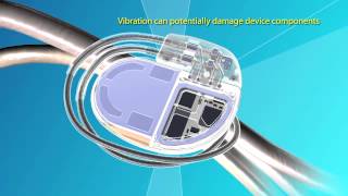 Medtronic Advisa™ DR MRI SureScan™ Pacemaker Video [upl. by Marigold980]