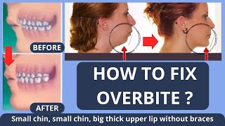 HOW TO FIX OVERBITE  SMALL CHIN BIG THICK UPPER LIP  WITHOUT BRACES NATURALLY [upl. by Marika]