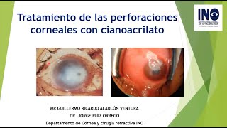 Tratamiento de perforaciones corneales con cianoacrilato Dr Ruiz Dr Alarcón Dr Minami [upl. by Kcirad811]