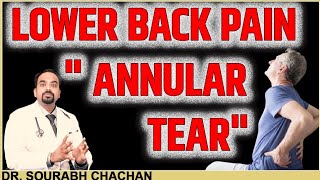 Lower Back Pain  ANNULAR TEAR  Dr Sourabh Chachan [upl. by Dania]