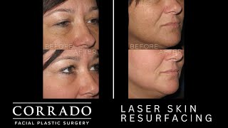 Fractional Laser Skin Resurfacing Treatment for SunDamaged Skin  Dr Anthony Corrado [upl. by Press]