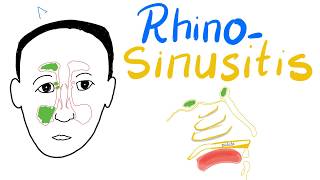 Rhinosinusitis Acuteamp Chronic Clinical Picture Diagnosisamp Management  Cases [upl. by Ru]