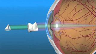 How Multifocal Contact Lenses Can Help Myopia Audio Description [upl. by Thurman]