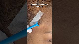 Quick and Safe Seborrheic Keratosis Removal Treatment at Dr Medispa [upl. by Hey956]