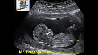 How To Do Fetal Biometry [upl. by Proud]