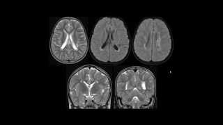 Leucomalácia periventricular [upl. by Ayokahs]