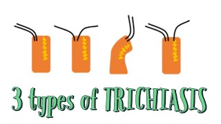 3 types of Trichiasis Distichiasis Entropion and Trichiasis EyeDocSkills [upl. by Aratas]