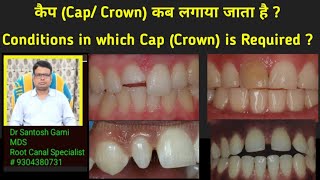 कैप Cap Crown कब लगाया जाता है Conditions in which Cap Crown is Required [upl. by Wilkens]