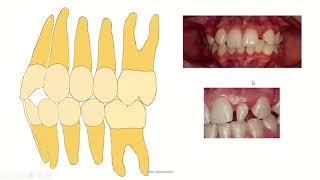 Bolton analysis for orthodontic undergraduate students [upl. by Solita]