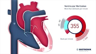 Ventricular Fibrillation V Fib amp Sudden Cardiac Death [upl. by Ecidna]