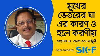 Mouth Ulcer Treatment  Aphthous ulcers canker sores  Mouth ulcers home remedy  মুখের ঘা [upl. by Ym]