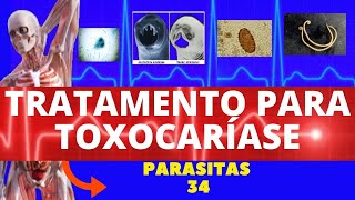 TRATAMENTO PARA TOXOCARÍASE TOXOCARA CANIS  PARASITOLOGIA  INFECTOLOGIA [upl. by Cleodel]