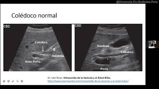 Ecografía de colédoco [upl. by Eednam]