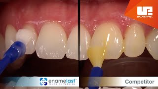 Enamelast™ fluoride varnish vs Competitor varnish [upl. by Michel574]