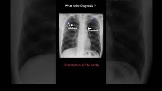 Coarctation of the aorta 96 chest xray Quiz Mediastinum amp Hilum radiologychannel007 [upl. by Raleigh456]