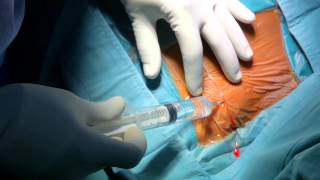 Pacemaker Implantation [upl. by Aihtnamas]