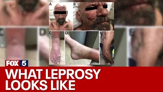 What is leprosy and why is it on the rise again  FOX 5 News [upl. by Nuncia]