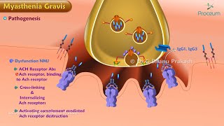 Myasthenia Gravis Etiology  Pathogenesis Classification  Clinical features Diagnosis Treatment [upl. by Svetlana]