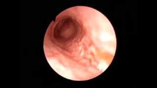 Gastroscopy Erosive antral gastritis [upl. by Vani559]