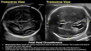 How To Measure Fetal Head Circumference HC On Ultrasound  Biometric Parameters  Obstetric USG [upl. by Bum135]