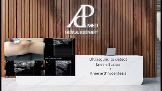 Ultrasound to detect knee effusion  knee arthrocentesis [upl. by Kcaj]