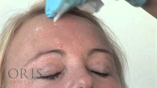 Botox training  Forehead Lines  Oris Medical [upl. by Terrel]