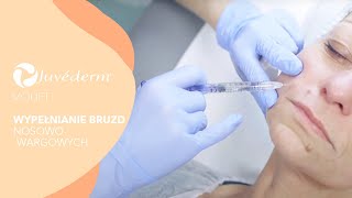 Wypełnianie bruzd nosowowargowych  JUVEDERM® VOLIFT  Klinika VESUNA [upl. by Oruam]