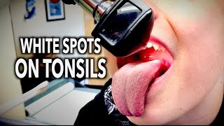 WHITE SPOTS ON TONSILS  Dr Paul [upl. by Einnij]