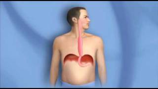 Surgery for Esophagus Cancer Esophagectomy  Mayo Clinic [upl. by Rankin]