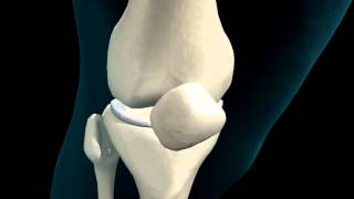 Knee Joint  Meniscus  3D Medical Animation  ABP © [upl. by Eibocaj]