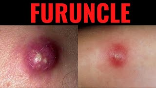 What is Furuncle Furuncle Boil DefinitionCauses Symptoms Risk Factors USMLE [upl. by Llehsam]