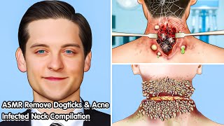 ASMR Deeply Cleansing Neck Infected with Acne and Dogticks [upl. by Evey]