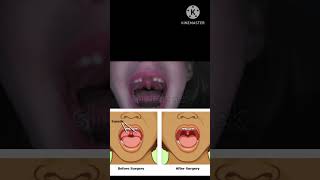 enlarged tonsils in children tonsillitistonsils tonsillectomy  remedies for enlarged tonsils [upl. by Tterraj]