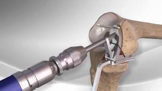 Partial Knee Replacement with the Arthrex® iBalance® UKA [upl. by Prunella]