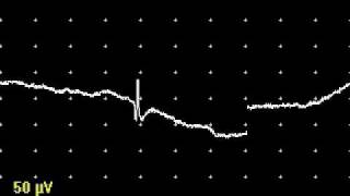 Positive Waves and Fibrillation Potentials [upl. by Dickens]