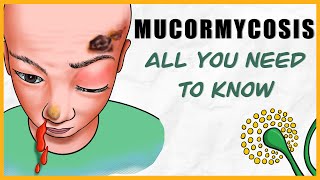 Mucormycosis microbiology types signs amp symptoms diagnosis treatment [upl. by Assetnoc]