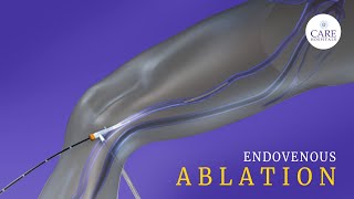 What is Endovenous Laser Ablation CARE Hospitals [upl. by Uriisa]