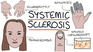 Systemic sclerosis APPROACH TO SKIN TIGHTENING [upl. by Llertram]