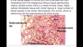 MSS Pathology  Fibrous Tumours amp FibrousLike Lesions [upl. by Navets906]