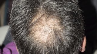 This is how stress affects hair loss [upl. by Ioj655]