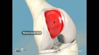 Patellofemoral Replacement [upl. by Ahselef823]