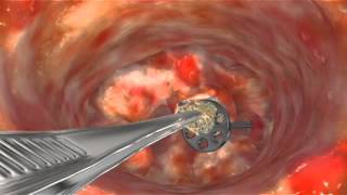 Animation Scar Tissue Removal to Release TORP [upl. by Jeri]