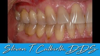 Bonding Gumline Abfraction  Dental Minute with Steven T Cutbirth DDS [upl. by Carolyn802]